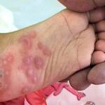 Bệnh tay chân miệng vào mùa: Những điều cần biết