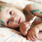 Dấu hiệu và cách chăm sóc bệnh nhân bị thủy đậu