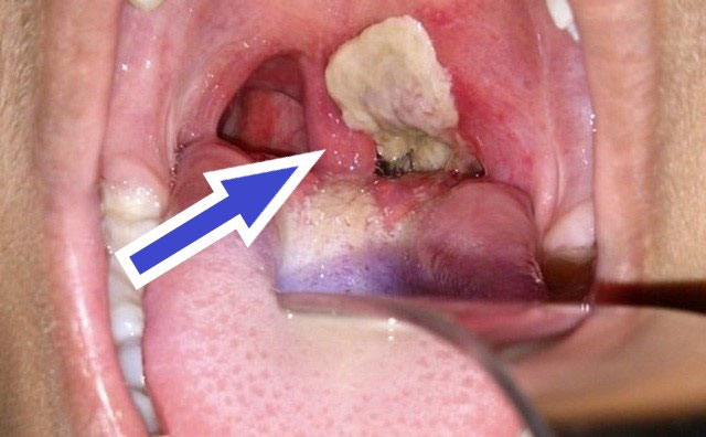 Bệnh nhân bạch hầu sẽ có giả mạc ở vùng hầu họng màu xám, rất dai, rất khó bóc tách ra khỏi niêm mạc.