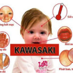 Bệnh Kawasaki: Nguyên nhân, triệu chứng và cách điều trị