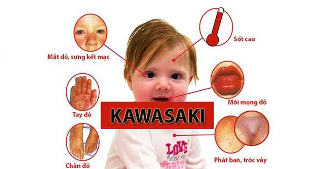 Bệnh Kawasaki: Nguyên nhân, triệu chứng và cách điều trị