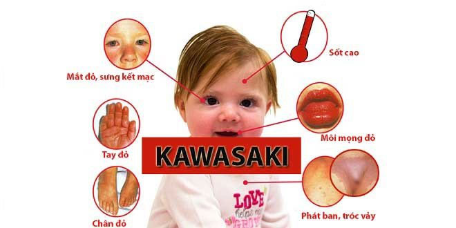 benh-kawasaki Một số biểu hiện của trẻ khi bị Kawasaki.