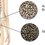 Top 4 loại thực phẩm là “Vua ăn cắp canxi”, khiến nhiều người ngã nhẹ đã gãy xương