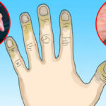 Cách chữa trị cho người bị bỏng lạnh
