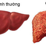 Bệnh xơ gan là gì? Ai dễ bị xơ gan nhất?